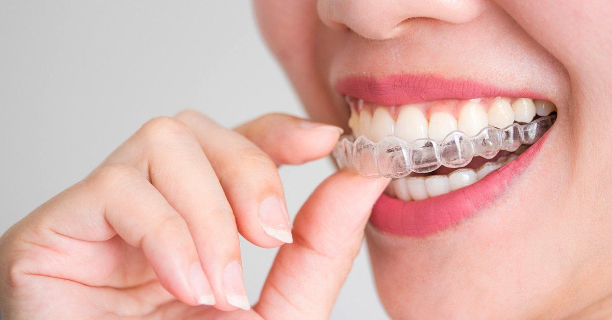 invisalign