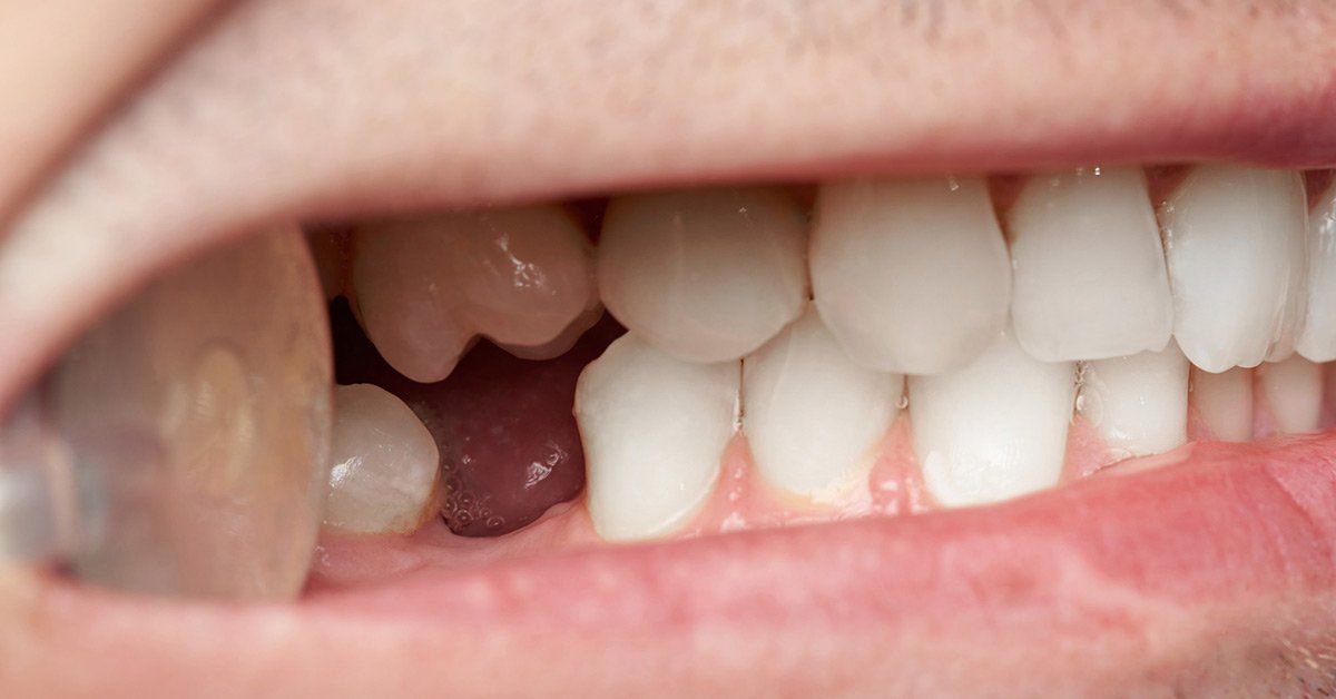 types of dental implants