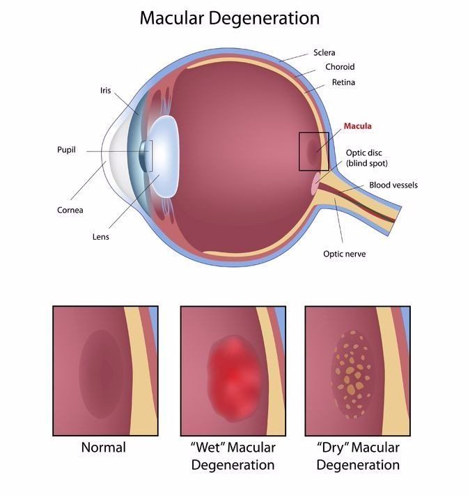 graph of  a normal macula, wet and dry macular degeneration
