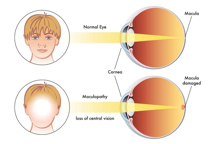 A diagram of a normal eye and a macular degeneration eye