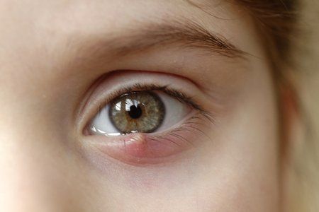 A stye or hordeolum on a lower eyelid