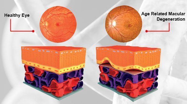 Healthy eye compared to an eye with macular degeneration