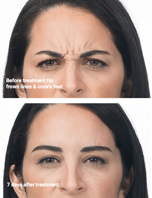 A before and after photo of a woman 's forehead after neurotoxin injections