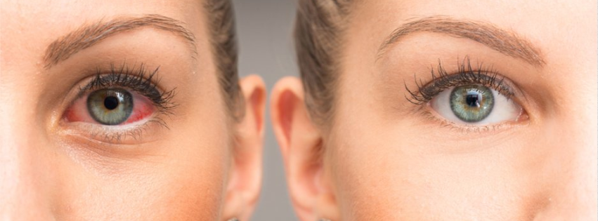 Side by side woman with red eye and clear eye
