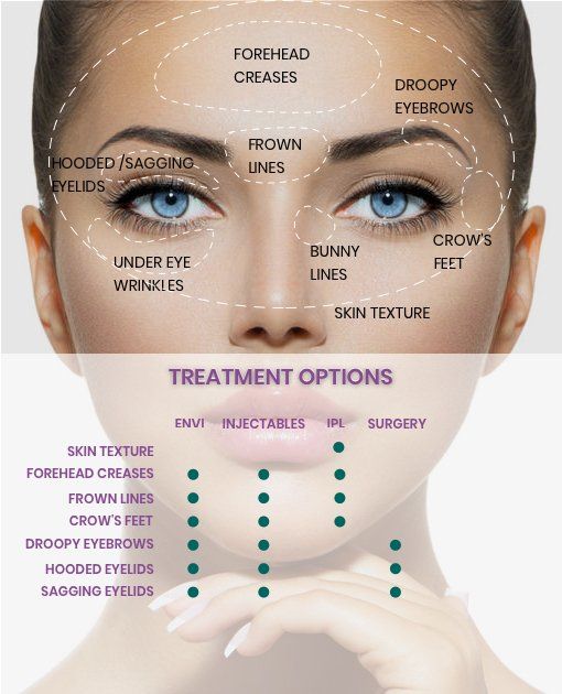 Woman's face showing injectable areas for treatment of wrinkles