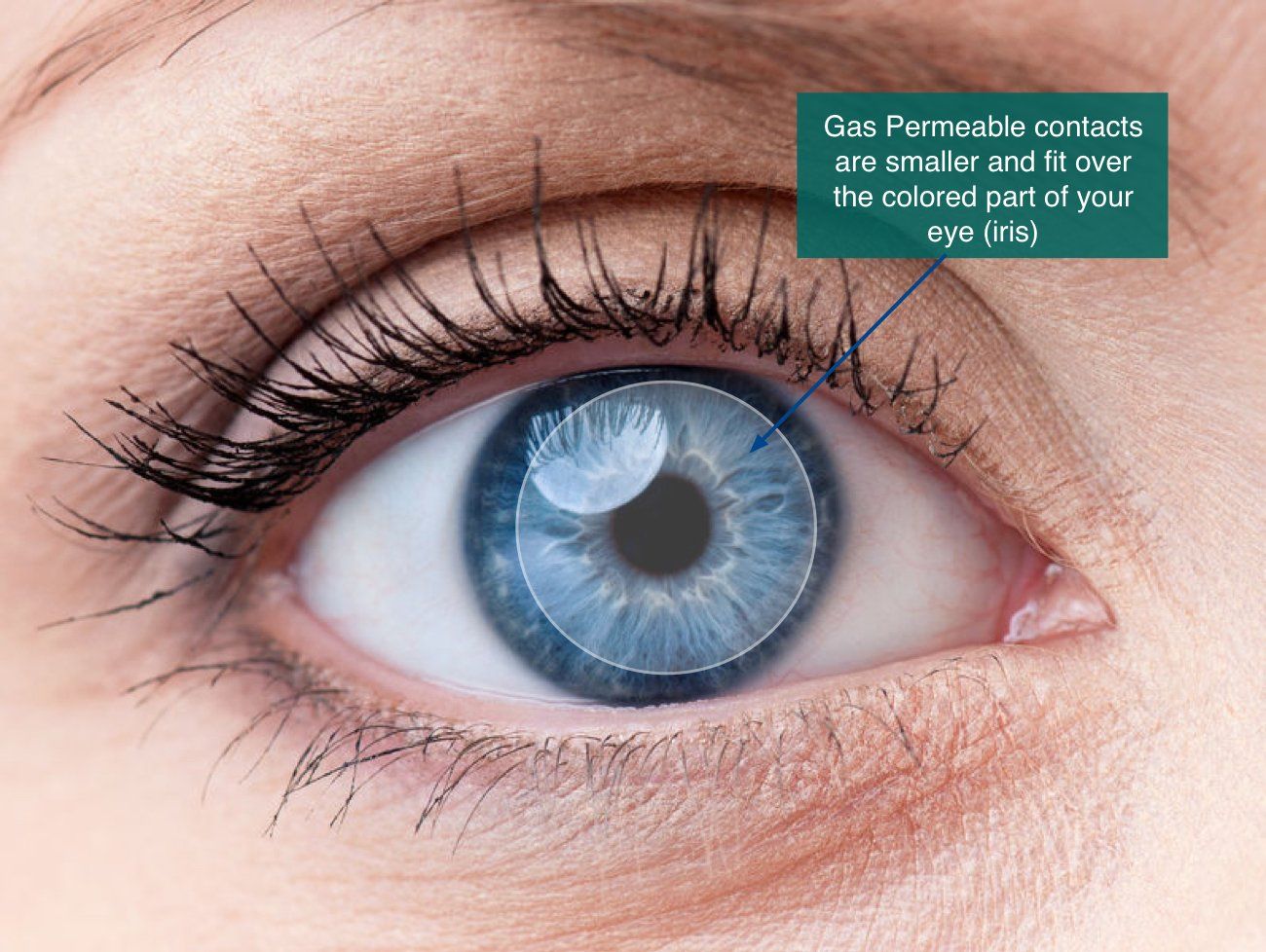 A close up of a woman 's blue eye with a gas permeable contact lens
