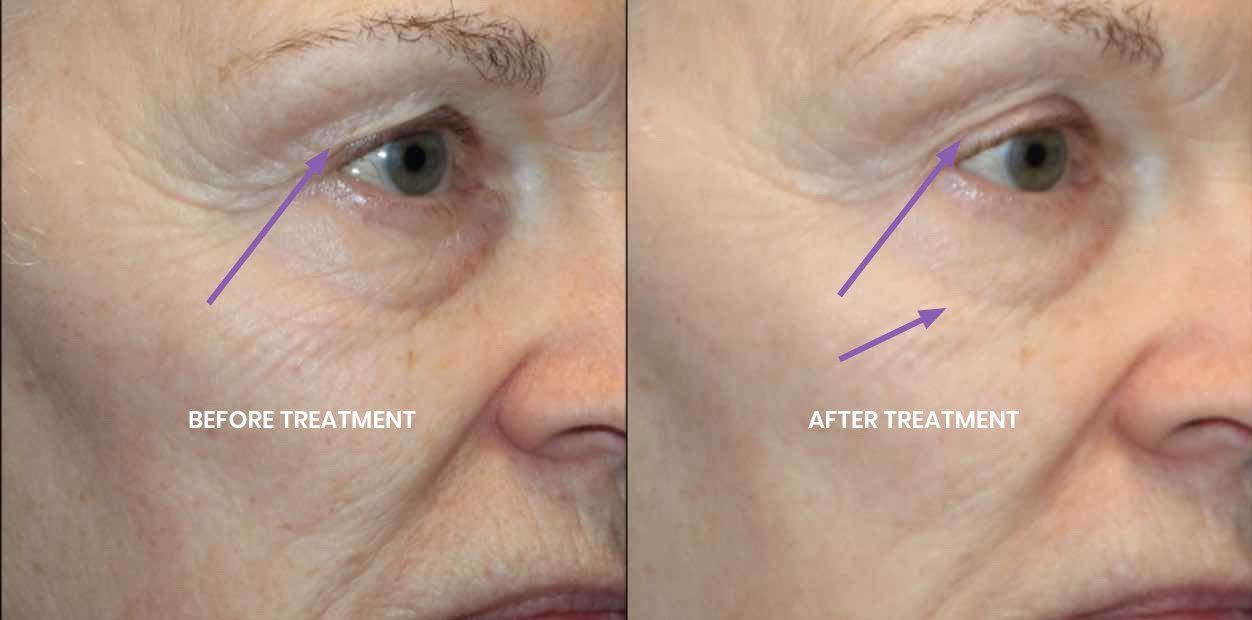 a woman before and after treatment with TempSure