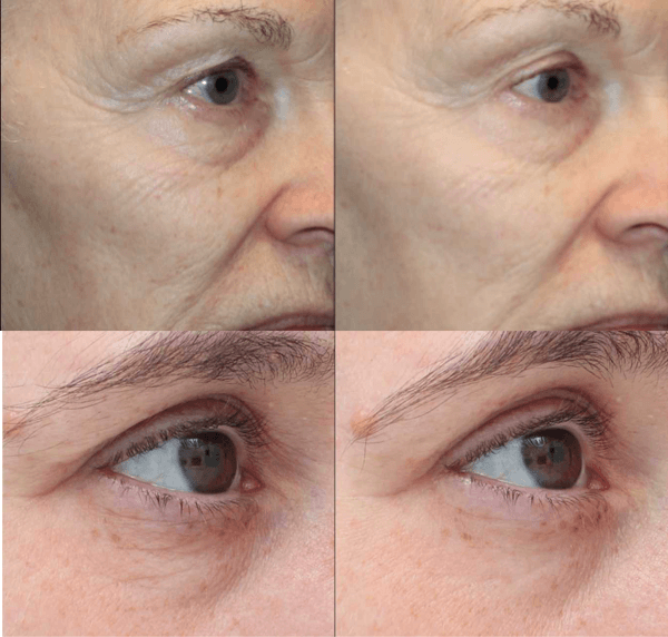 A before and after photo of a woman 's face