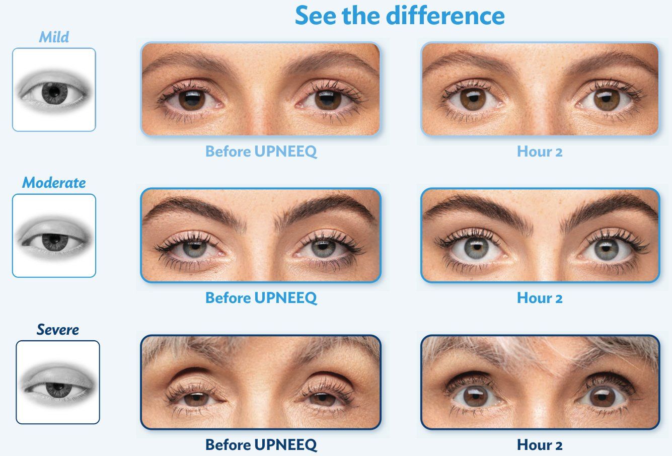 Upneeq eye drops lift droopy eyelids