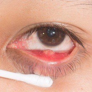 A chalazion in lower eyelid