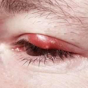 A chalazion appearing on the upper eyelid of an adult