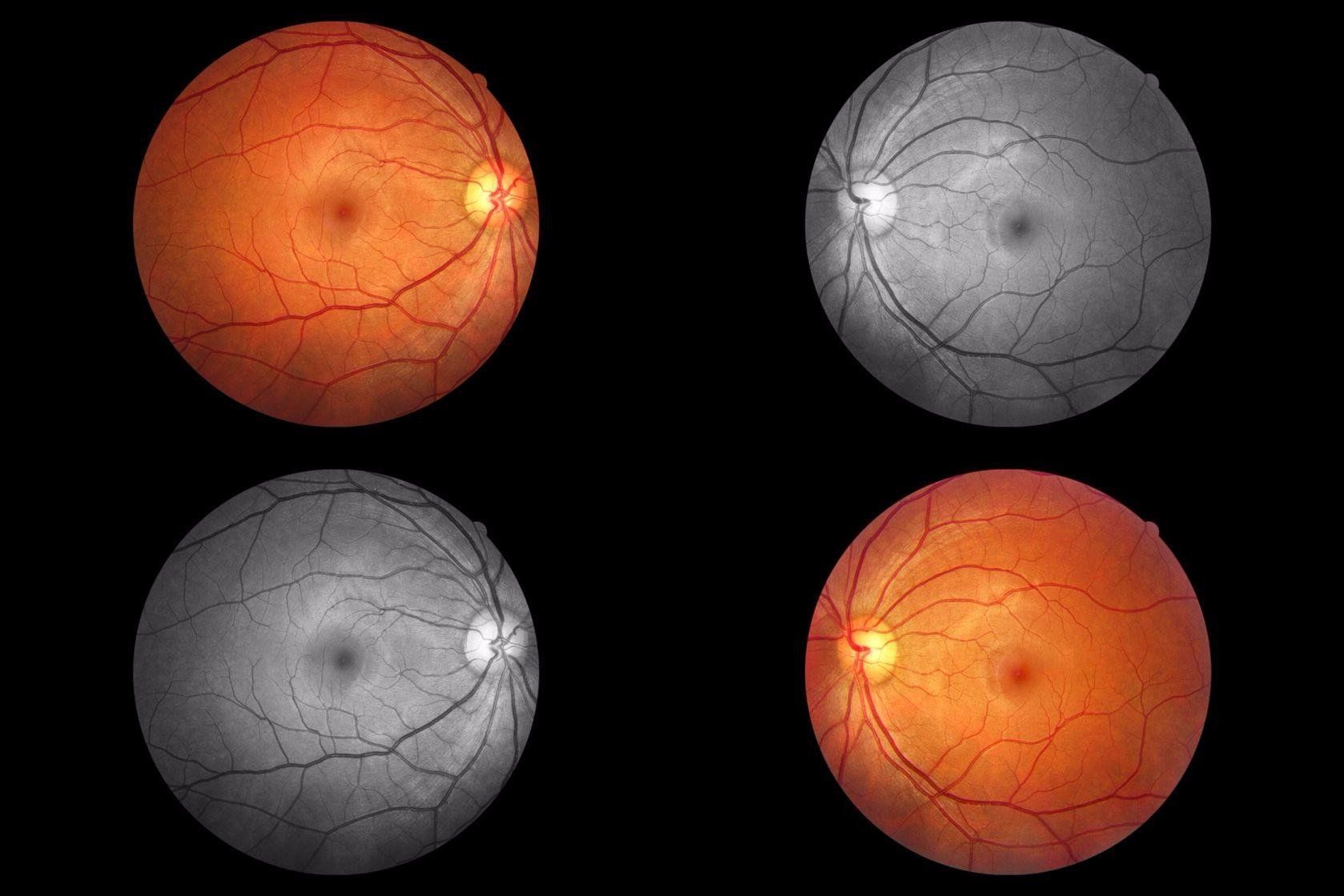 photo collage of fundus photography