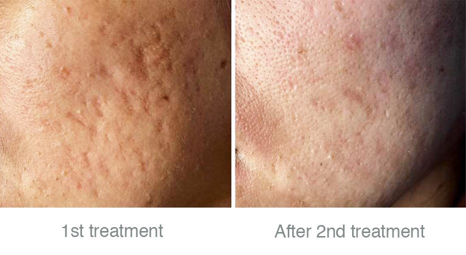 before and after microneedling treatment