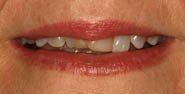 Crooked teeth