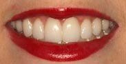 After Missing Teeth