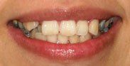 Missing Teeth
