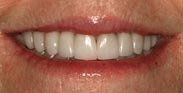 after Crooked Teeth
