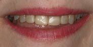 Small Teeth
