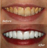 Before and After Teeth Whitening