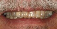 before Veneers