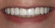 After Worn Teeth
