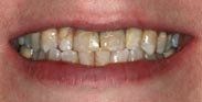 Worn Teeth