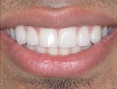 smile after bonding
