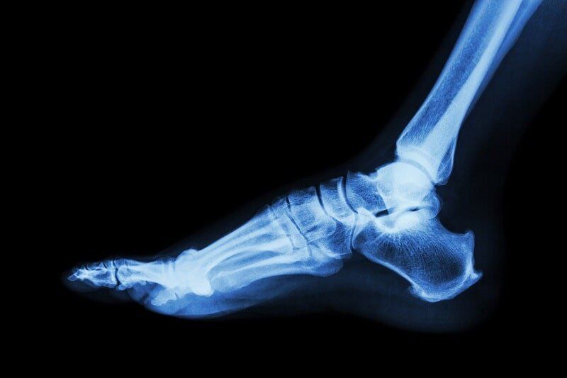 foot x ray foot x ray