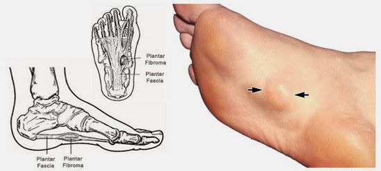 Fibromatosis — About Plantar Fibromatosis in Ladson, SC Fibromatosis — About Plantar Fibromatosis in Ladson, SC