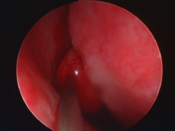 chirurgia endoscopica