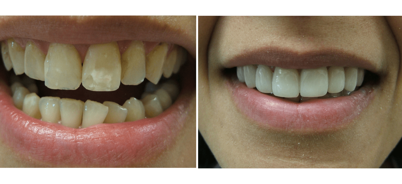 Before and After Veneers — Richmond, VA — Dr. Babik & Associates