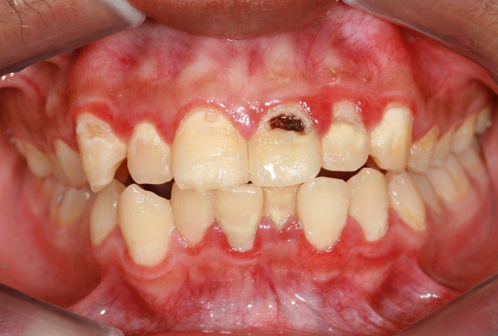 Periodontal Treatment — Richmond, VA — Dr. Babik & Associates