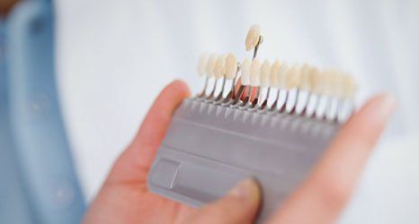 dental veneers
