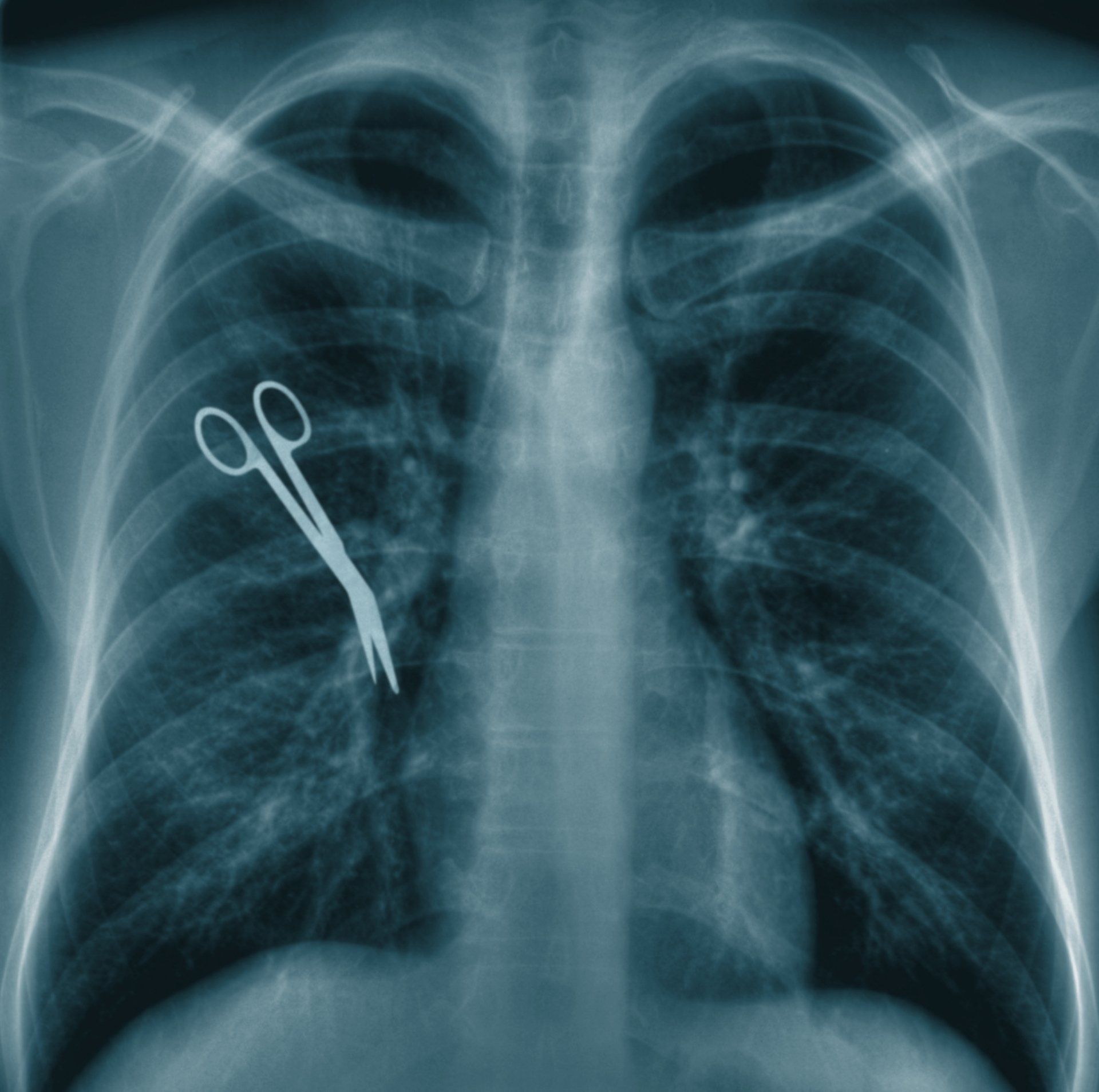 X-ray of chest with surgical scissors lodged inside the left lung.