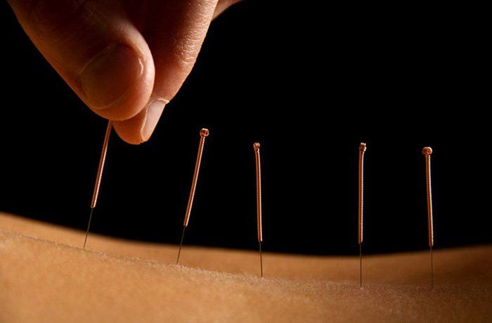 Acupuncture Vancouver downtown