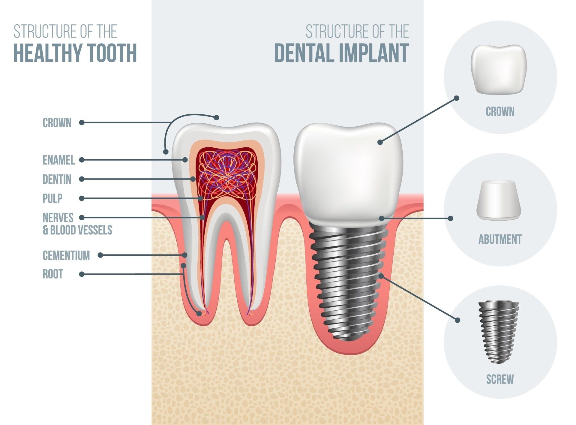 Diagram comparing a healthy tooth to a dental implant. Showing parts: crown, enamel, dentin, pulp, roots, implant, and abutment.