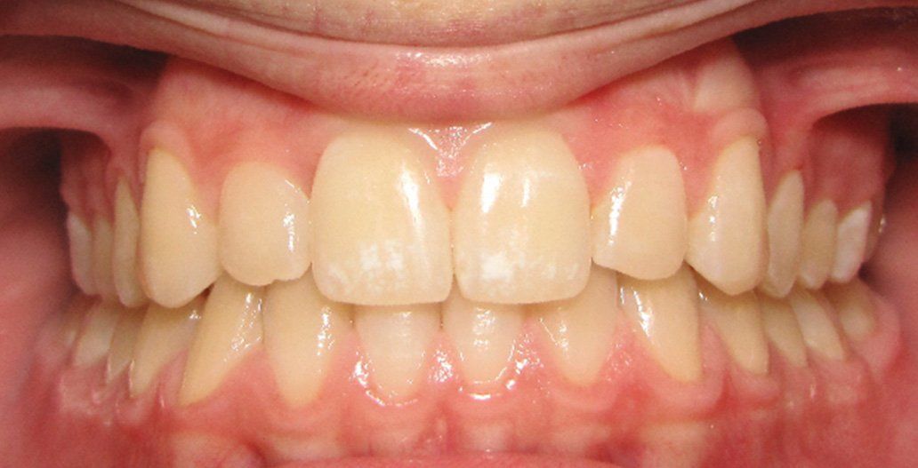 After invisalign treatment Cicinnati OH
