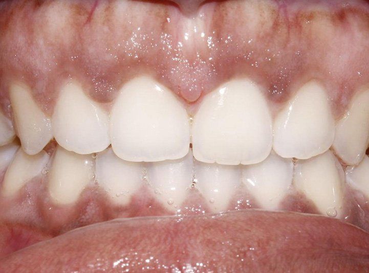 After invisalign braces in Cicinnati OH
