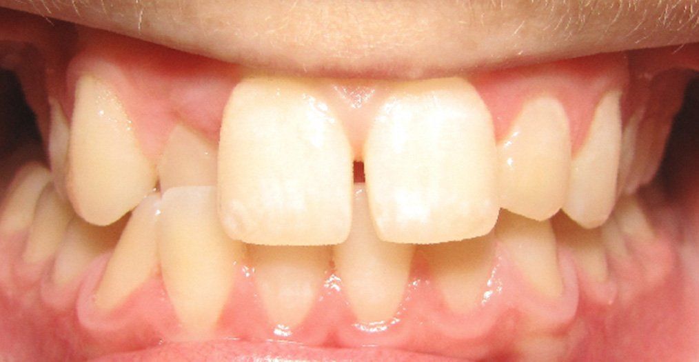 After invisalign treatment in Cicinnati OH