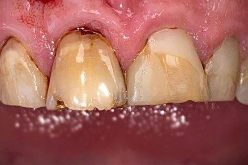 After invisalign treatment in Cicinnati OH