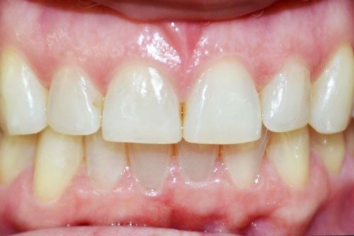 After invisalign braces in Cicinnati OH