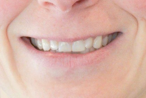After invisalign treatment in Cicinnati OH