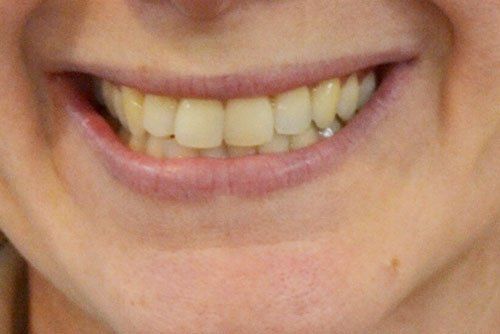 After invisalign treatment in Cicinnati OH