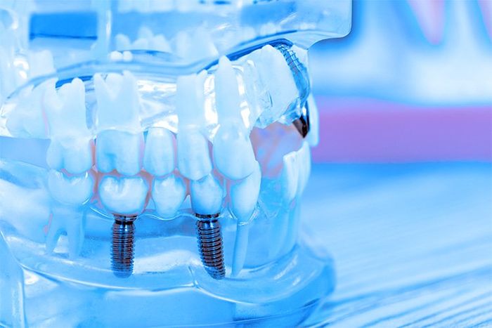 Model of Dental Implants in Cincinnati, OH