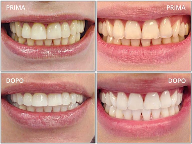 sbiancamento laser
