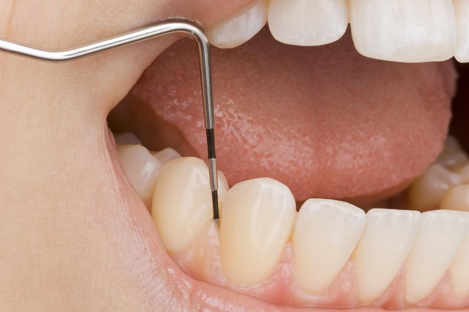 Pulizia dentale