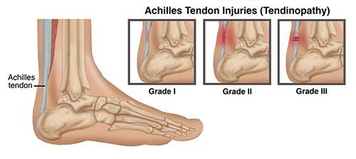 Achilles Tendon Injury