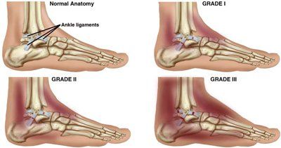 AnkleSprains-Small