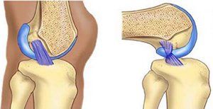Anterior Cruciate Ligament (ACL) Attachment
