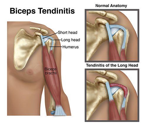 Biceps Tendinitis